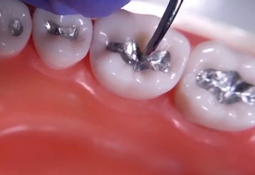 Dental amalgam fillings Facts