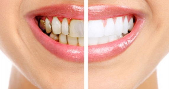 Teeth whitening